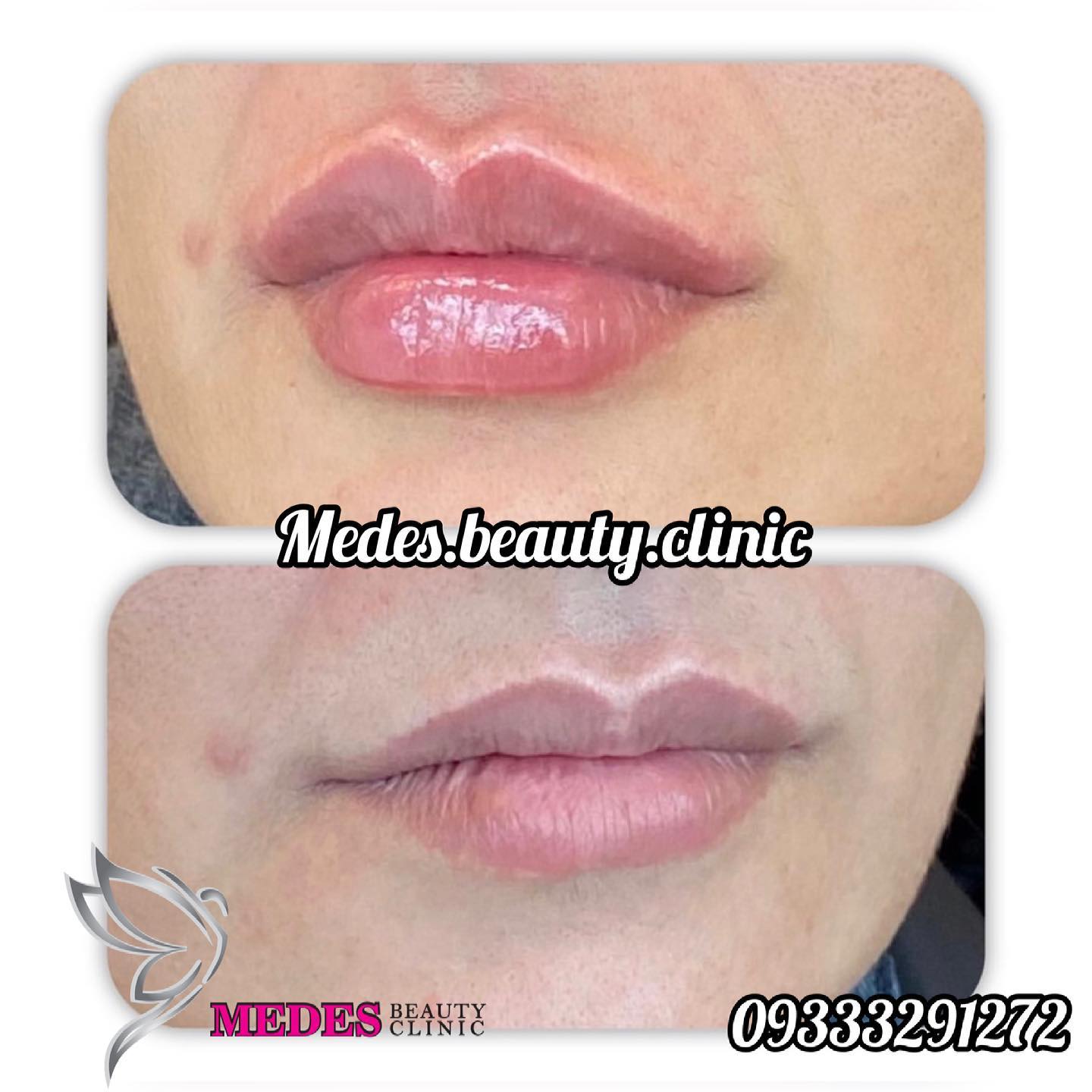 گالری تزریق ژل لب